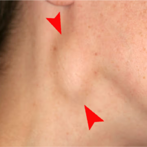 Causes of a Pea-Sized Lump in the Neck