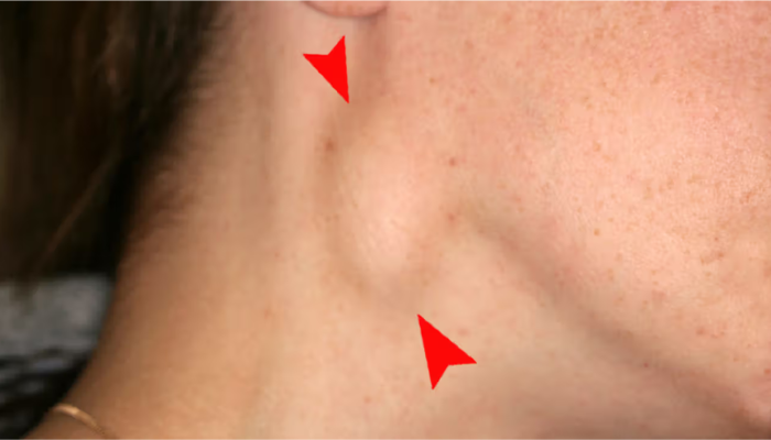 Causes of a Pea-Sized Lump in the Neck