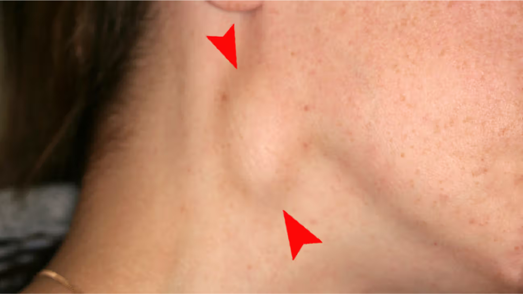 Causes of a Pea-Sized Lump in the Neck