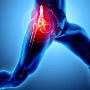 Sports Medicine Hip Flexor Strain