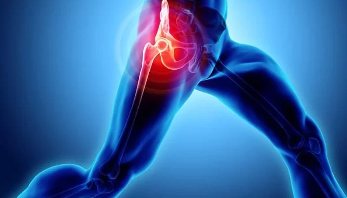 Sports Medicine Hip Flexor Strain